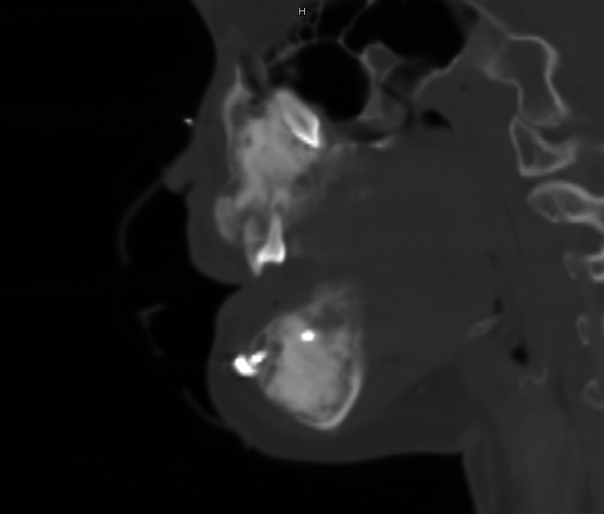 電腦斷層影像可見左側上顎犬齒位於左側眼球下方